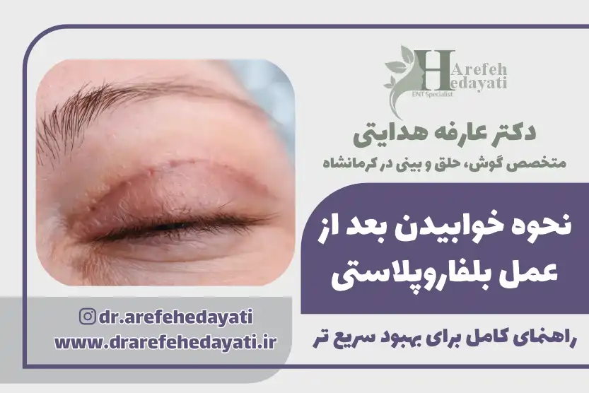نحوه خوابیدن بعد از عمل بلفاروپلاستی