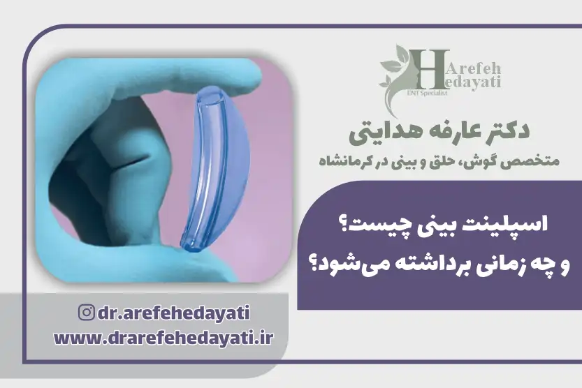 اسپلینت بینی چیست؟ و چه زمانی برداشته می شود؟