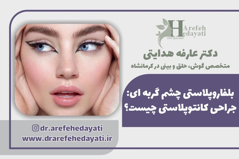 بلفاروپلاستی چشم گربه ای جراحی کانتوپلاستی چیست؟