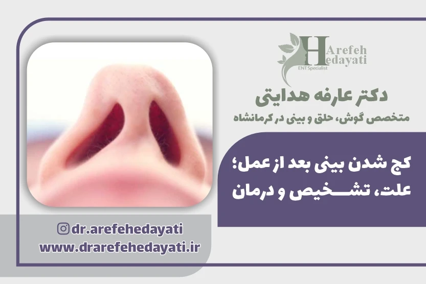 کج شدن بینی بعد از عمل علت، تشخیص و درمان
